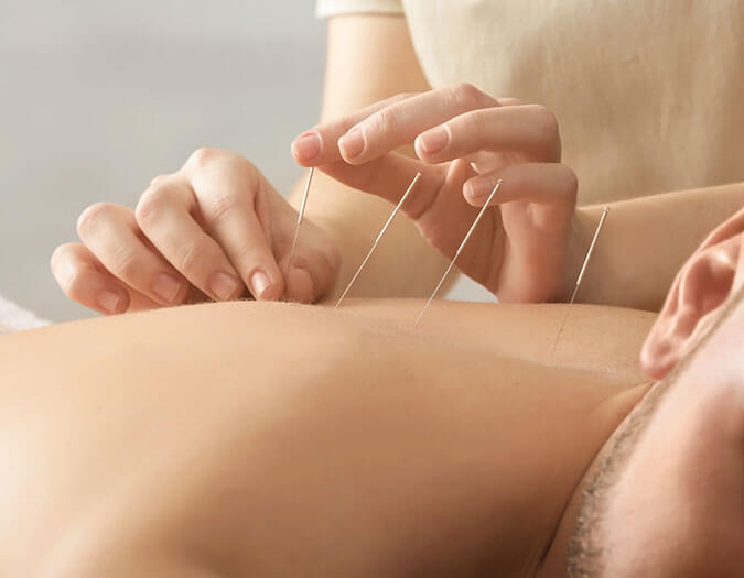 Acupuncturist inserting needle into male back